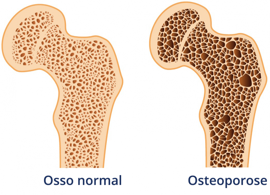 OSTEOPOROSE