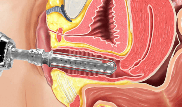 REJUVENESCIMENTO DA REGIÃO ÍNTIMA: USO DE LASER E RADIOFREQUÊNCIA