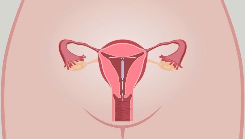MÉTODOS CONTRACEPTIVOS HORMONAIS DE LONGA DURAÇÃO
