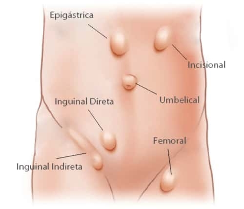 HÉRNIAS DA PAREDE ABDOMINAL: TRATAMENTO É A CIRURGIA!