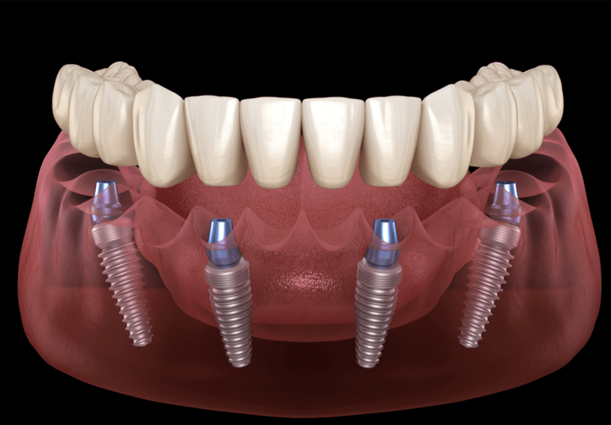 Implantes dentários & próteses tipo protocolo
