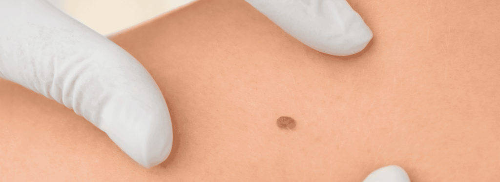 Fim do verão acende alerta para cancêr de pele, tratamento e prevenção da doença