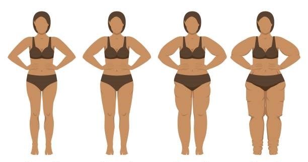 Lipedema: Desvendando a doença silenciosa que afeta milhares de mulheres
