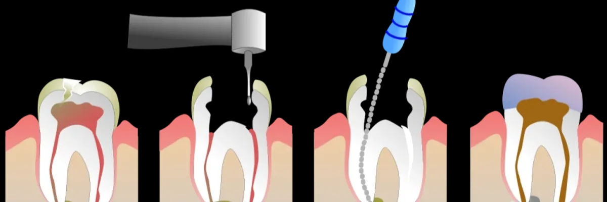 Tratamento de Canal: tudo o que você precisa saber