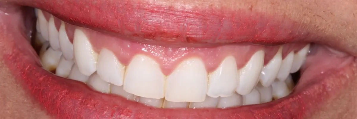 Cirurgia Plástica Gengival:  A solução para o sorriso gengival