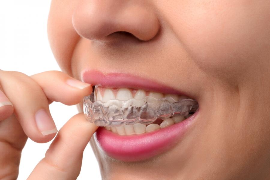 Capa do artigo APARELHO INVISÍVEL É A MAIS NOVA OPÇÃO PARA OS DENTES