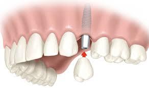 Capa do artigo IMPLANTES DENTÁRIOS