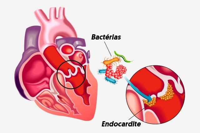 Capa do artigo Endocardite Infecciosa: o coração e a boca  Endocardite é uma doença que provoca inflamação na membrana que reveste a parede interna do coração e uma de suas causas é a má conservação dos dentes