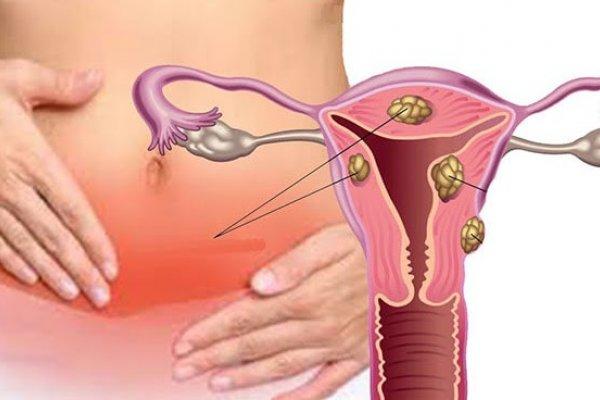 Capa do artigo Tudo sobre Mioma Uterino: o que é, sintomas, cirurgia e tratamento O mioma uterino, comum em mulheres entre os 40 e os 50 anos de idade, apresenta sintomas desconfortáveis, pode causar infertilidade e também passar despercebido na vida de uma mulher.