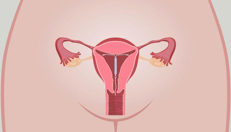Capa do artigo MÉTODOS CONTRACEPTIVOS HORMONAIS DE LONGA DURAÇÃO