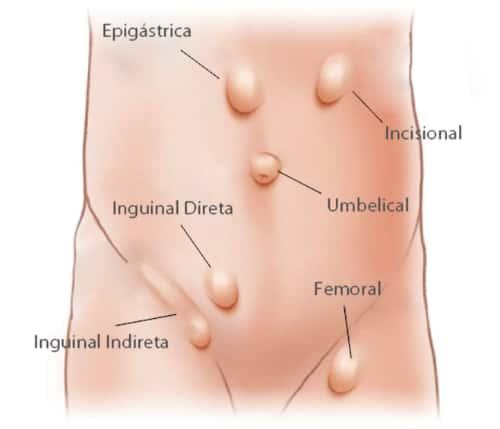 Capa do artigo HÉRNIAS DA PAREDE ABDOMINAL: TRATAMENTO É A CIRURGIA!