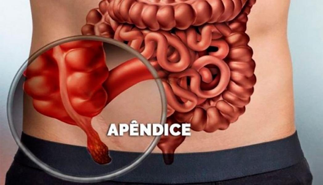 APENDICITE AGUDA: QUANDO PROCURAR ATENDIMENTO