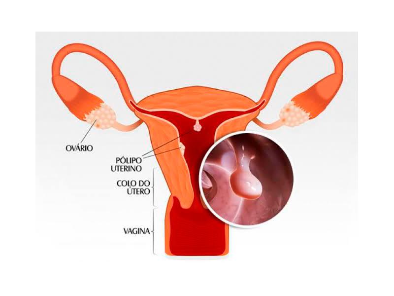Capa do artigo Pólipos endometriais