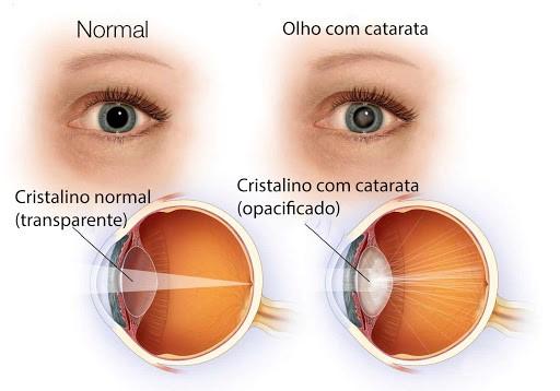 Capa do artigo CATARATA: O QUE É, SINTOMAS, DIAGNÓSTICO E TRATAMENTO