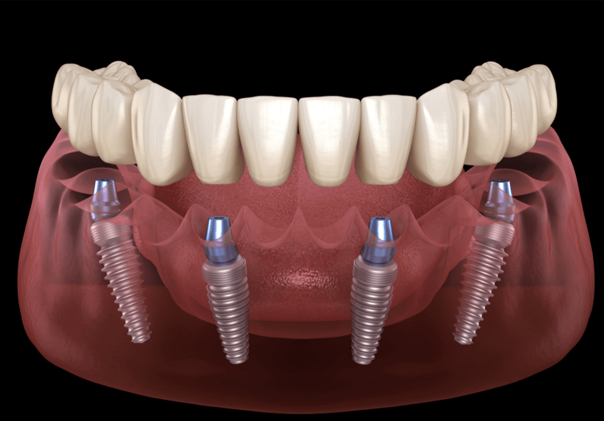 Implantes dentários & próteses tipo protocolo