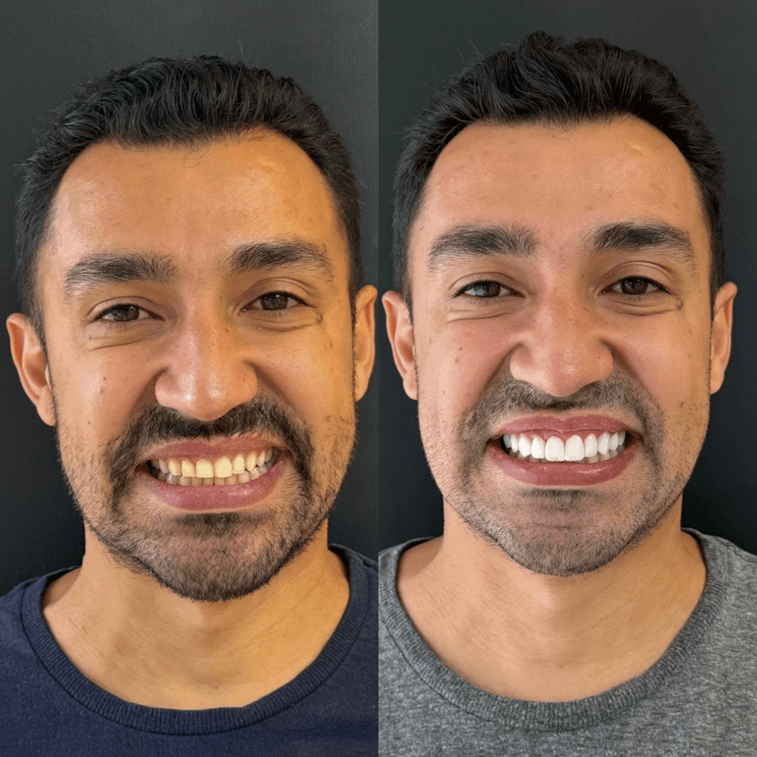 Facetas em Resina: Restauração e Beleza Natural para o Seu Sorriso