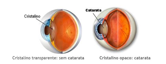 É obrigatório colocar lente quando se opera a catarata?