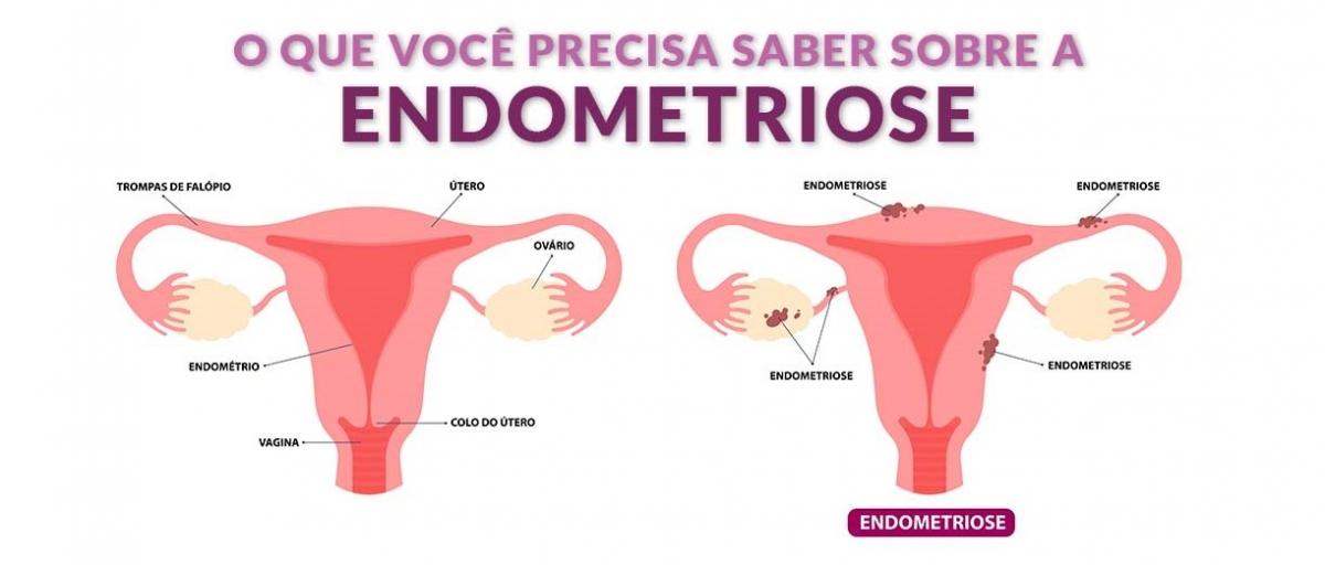 Endometriose: o que é, causas e diagnóstico