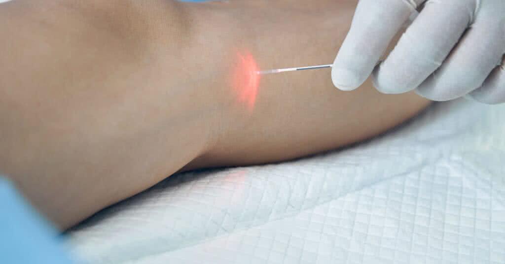 Laser endovenoso: O que é, como funciona e quais suas vantagens