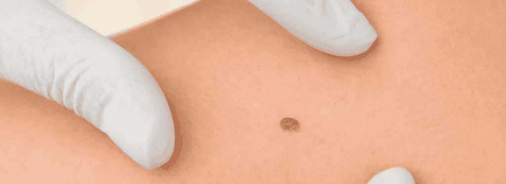 Fim do verão acende alerta para cancêr de pele, tratamento e prevenção da doença