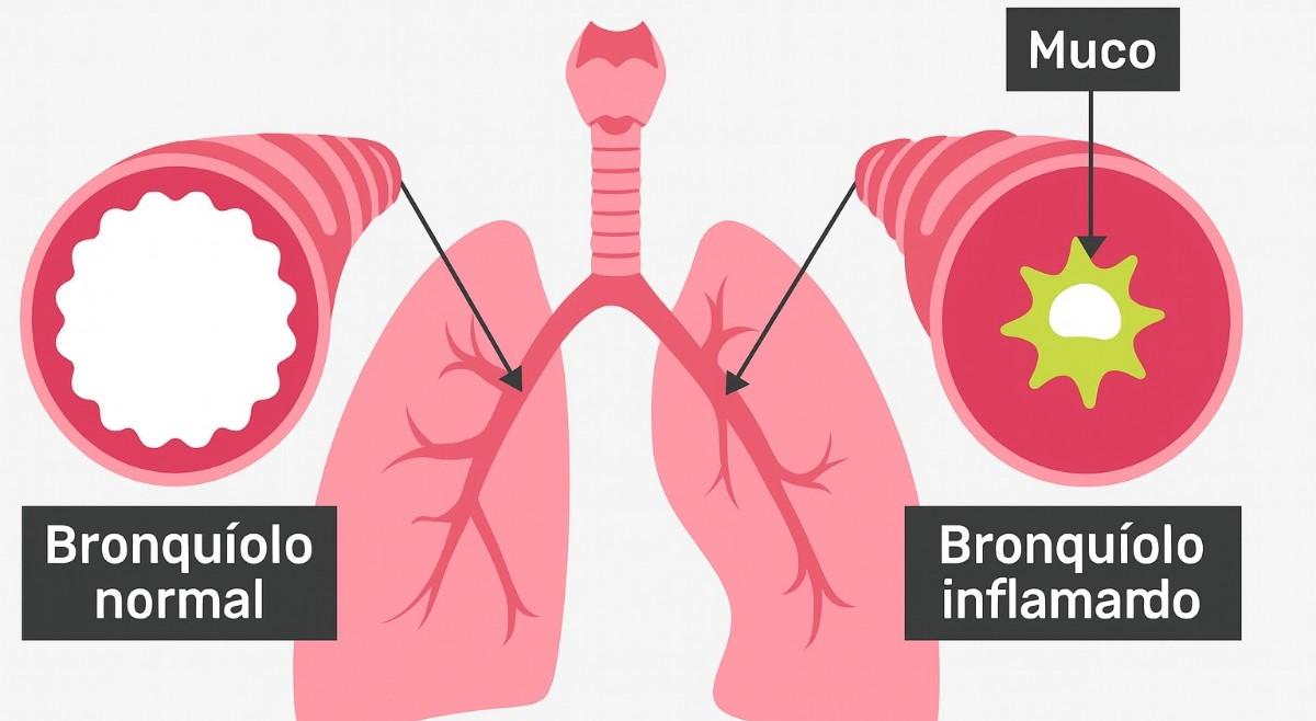 Bronquiolite viral aguda: Principais sintomas e prevenção