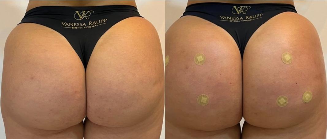 Harmonização de glúteos: A nova tendência da estética corporal