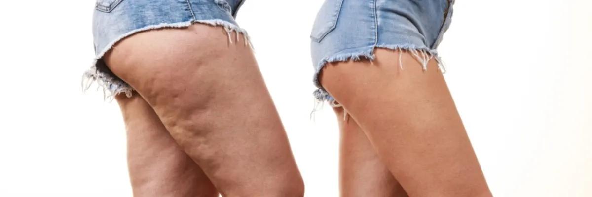 Lipedema: Como eu trato?