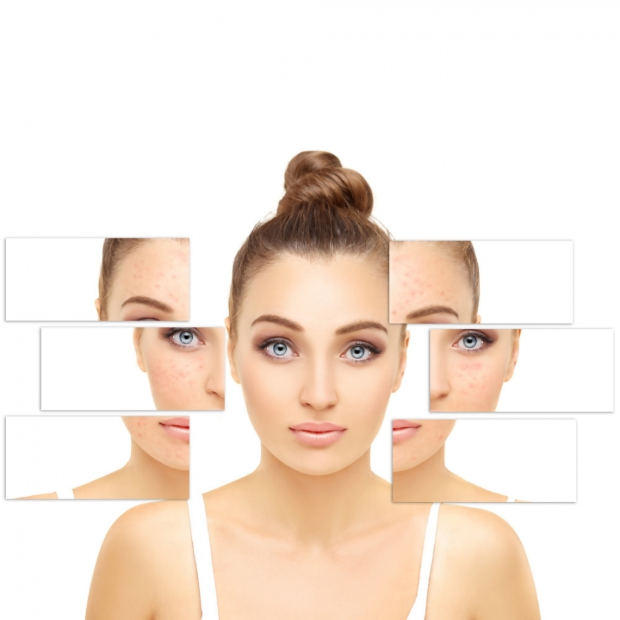 ESPINHAS E CRAVOS, UM PROBLEMA NÃO SÓ DOS ADOLESCENTES