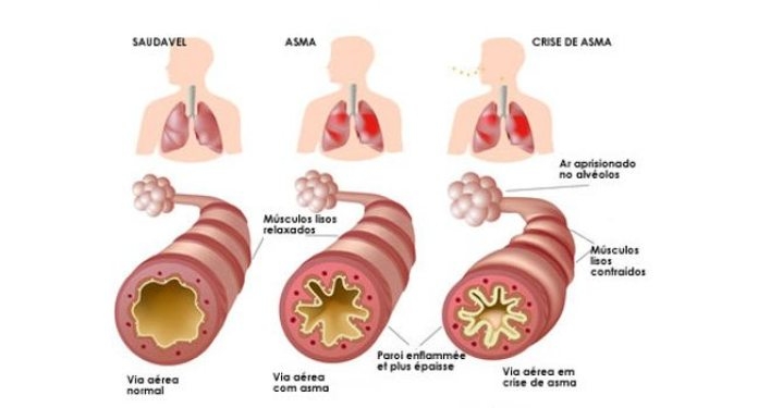 ASMA: CAUSAS, SINTOMAS E DIAGNÓSTICO