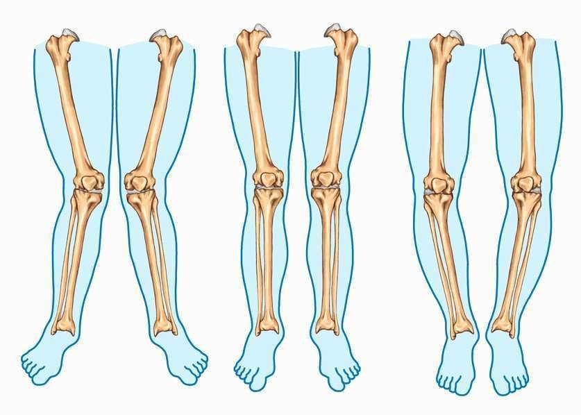 deformidades dos joelhos na infância