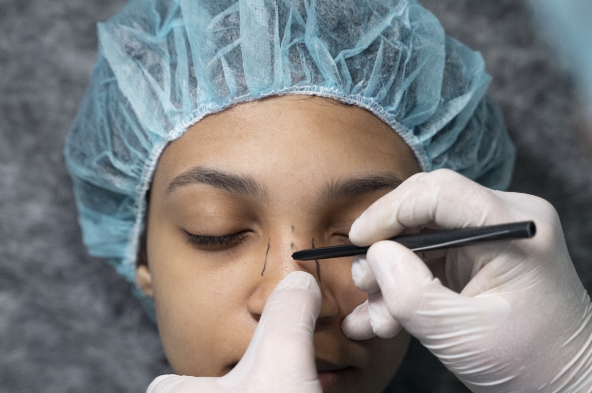 Rinoplastia revisional com cartilagem de costela: Um novo Horizonte na reconstrução nasal